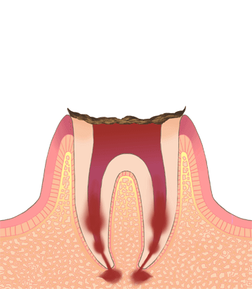C4　歯の根まで進行した虫歯