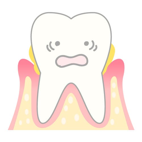歯周病の場合