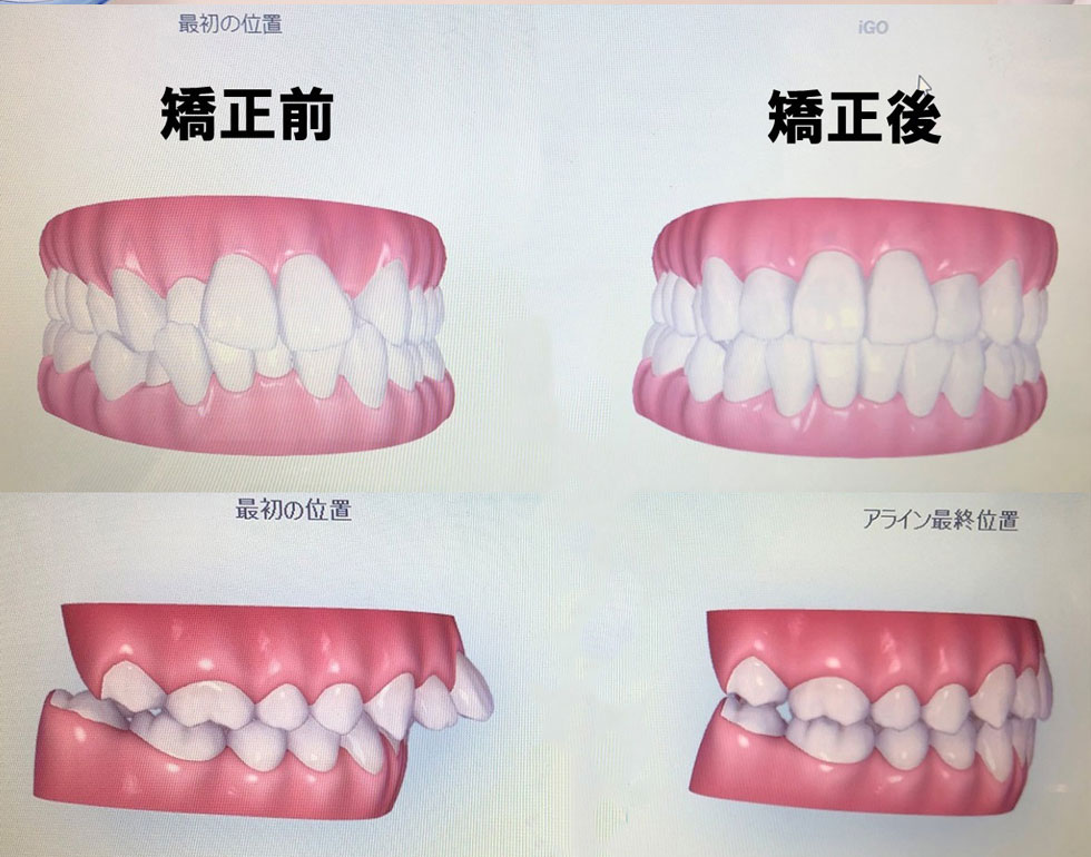 光学式スキャナーiTeroで治療後の歯並びを事前に確認可能